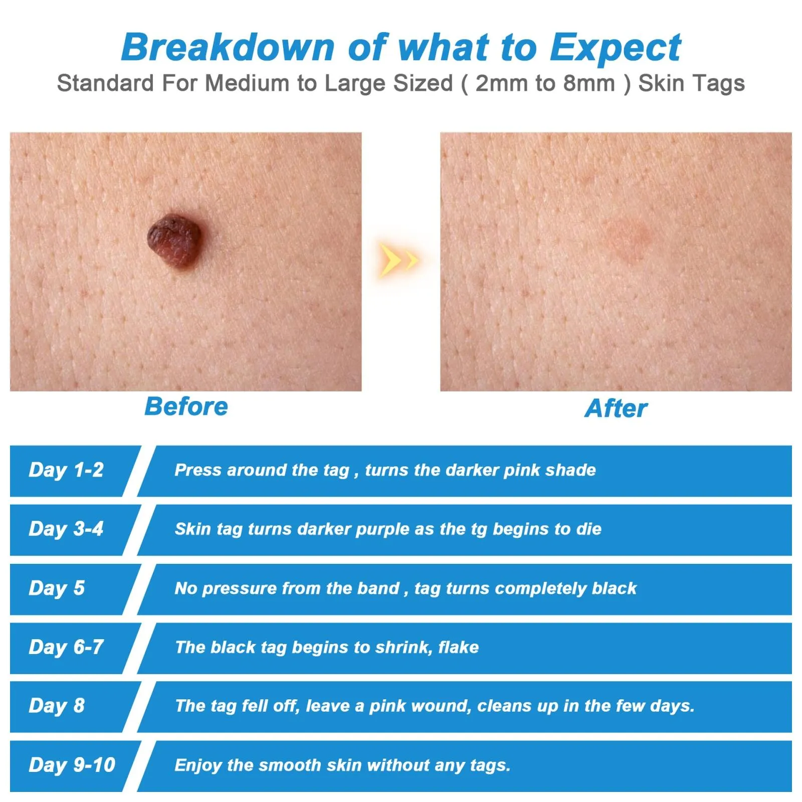 2 In 1 Skin Tag & Mole Remover Face Care Beauty Tool For Adults